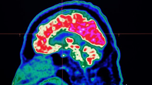 La inteligencia artificial reduce el riesgo de secuelas por un derrame cerebral