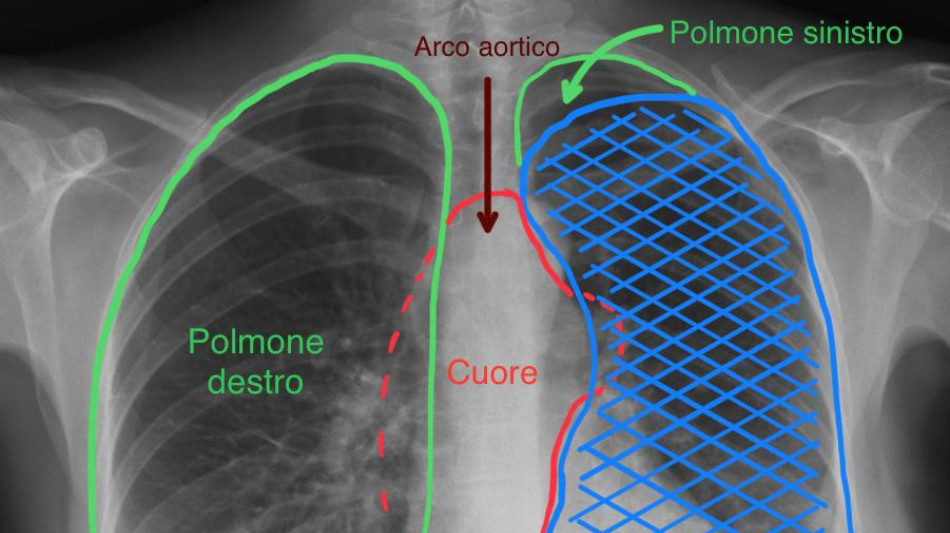 Grande tumore asportato alle Molinette sollevando il cuore