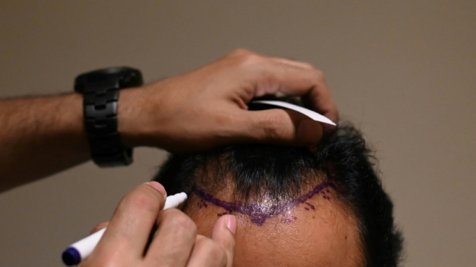 Hair transplant fad turns deadly in India